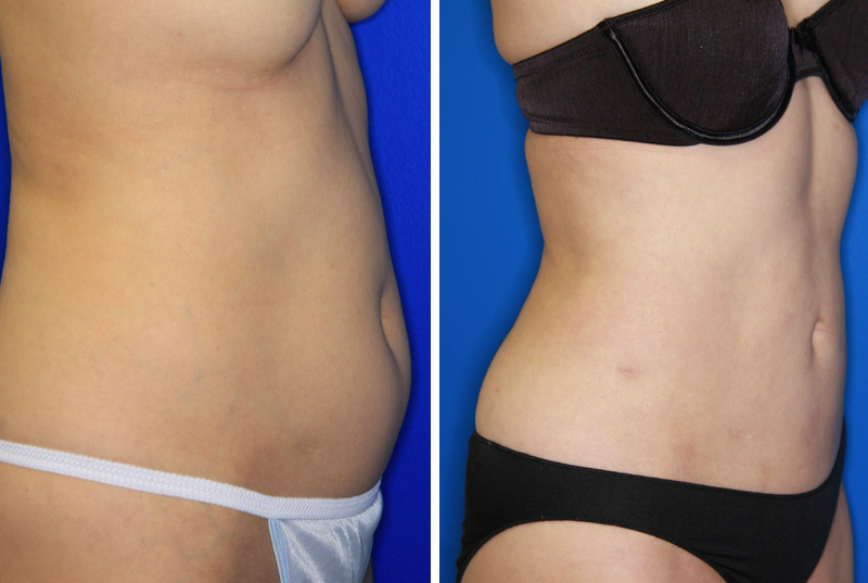 liposuction-surgery-transgender-body-surgical-procedures-beverly-hills-surgeon-los-angeles