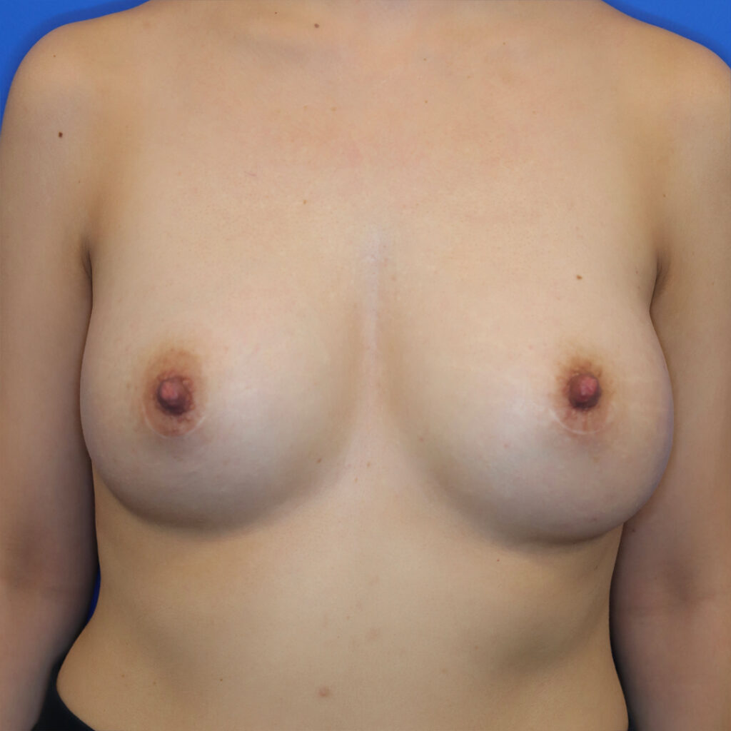       Beverly Hills Plastic Surgery Breast Augmentation After Photo