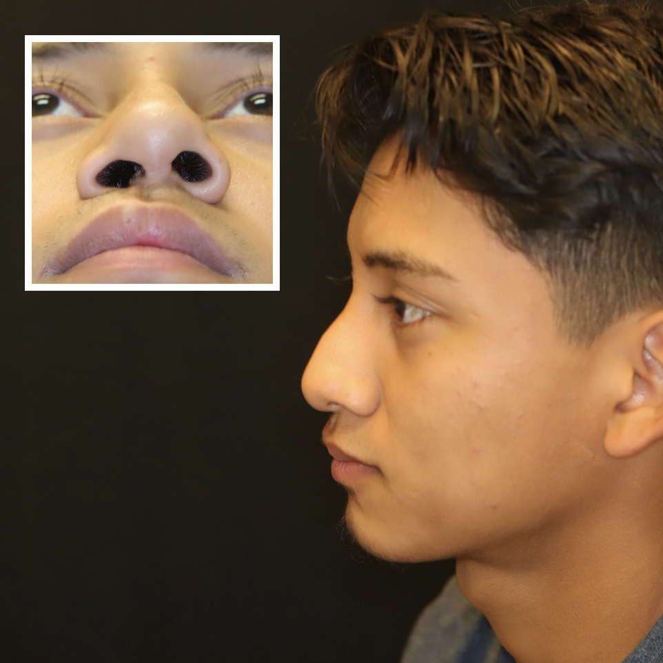 Rhinoplasty-Nose-Nostril-Los-Angeles-Beverly-Hills-Plastic-Surgeon-Surgical-Procedure-After-Photo-Patient