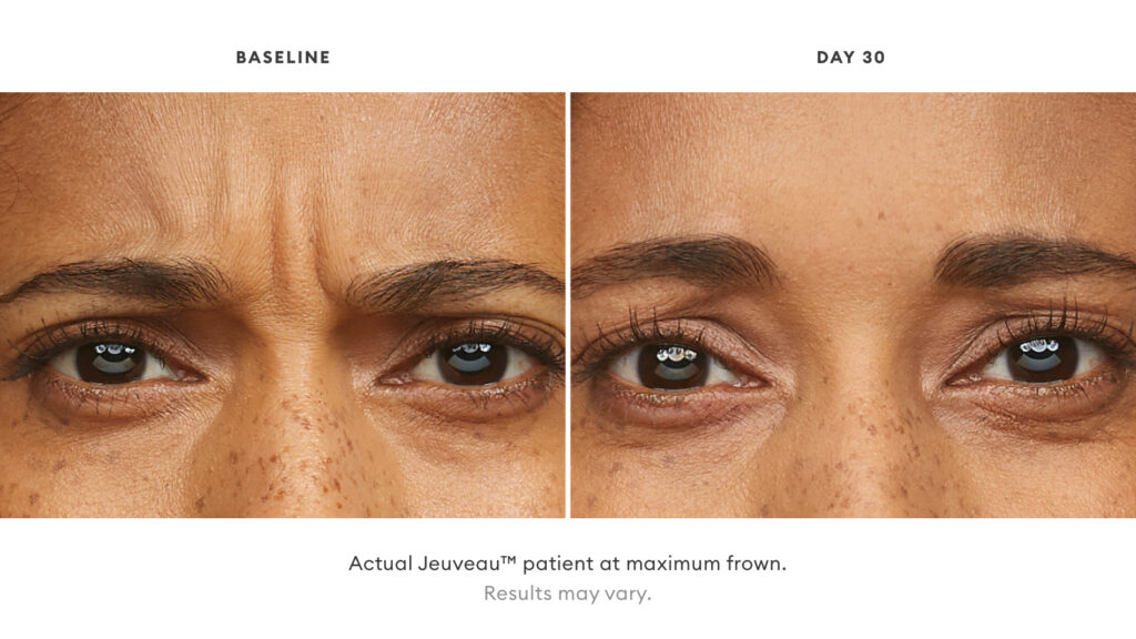 jeuveau injectables for facial rejuvenation in los angeles before and after