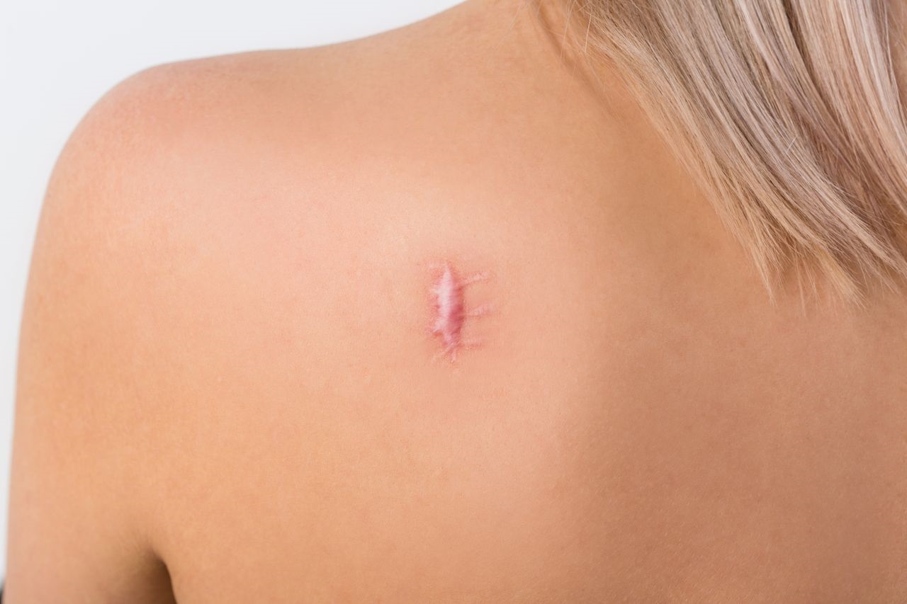 Dr. Alex KimDr. Alex Kim | Beverly Hills Plastic Surgeon, MD| Beverly Hills Plastic Surgeon, MD keloid scar treatment los angeles beverly hills california dr kim