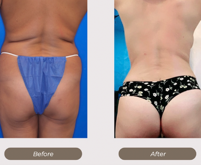 Liposuction: Before&After